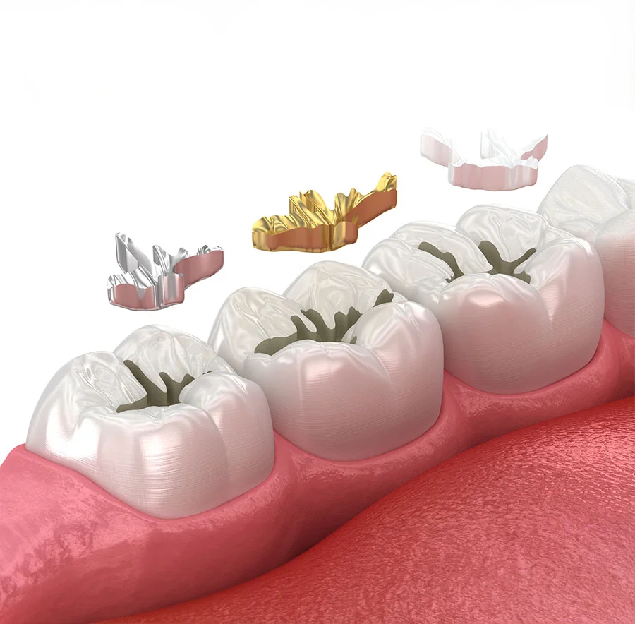 newest-dental-fillings-first-step